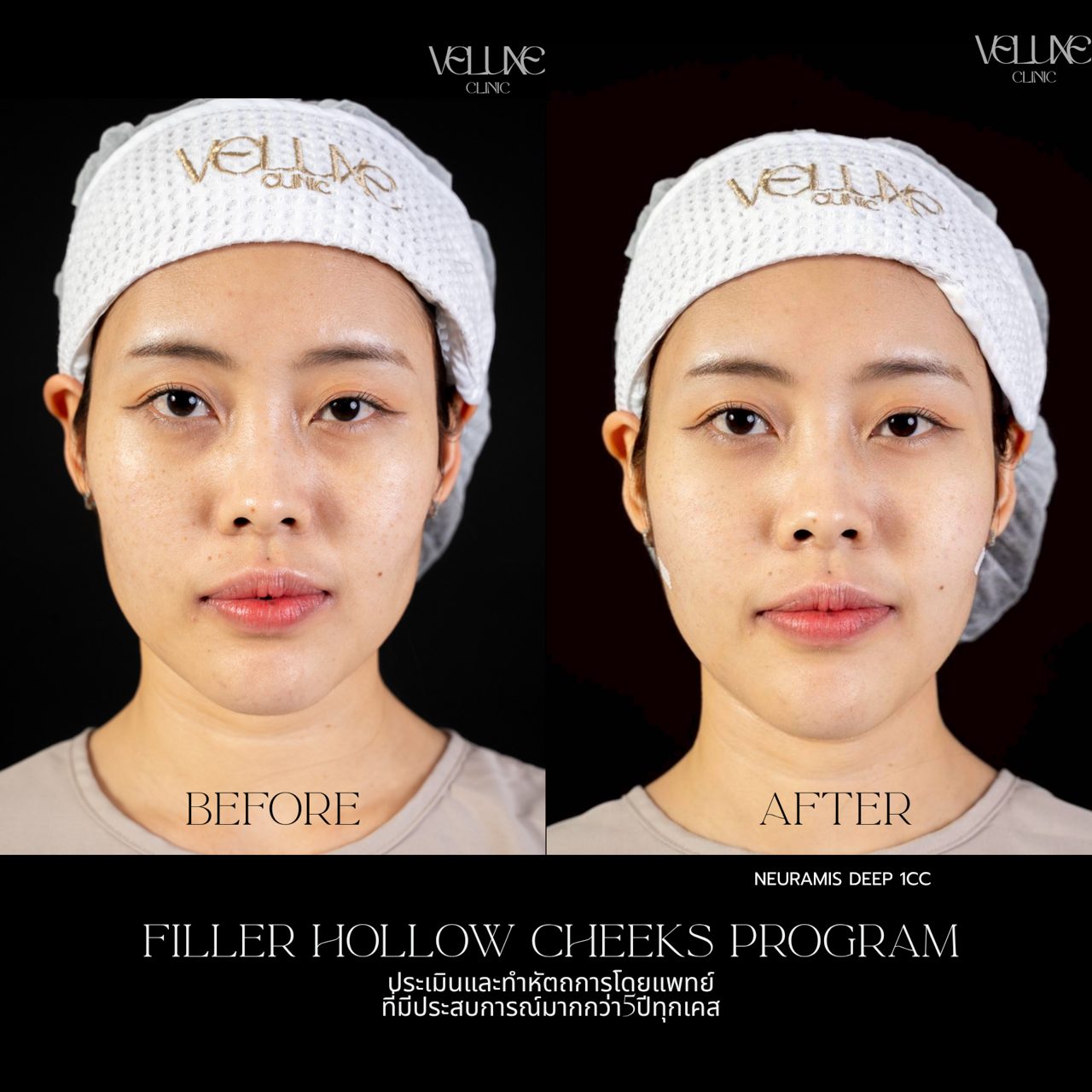 Filler แก้มตอบ