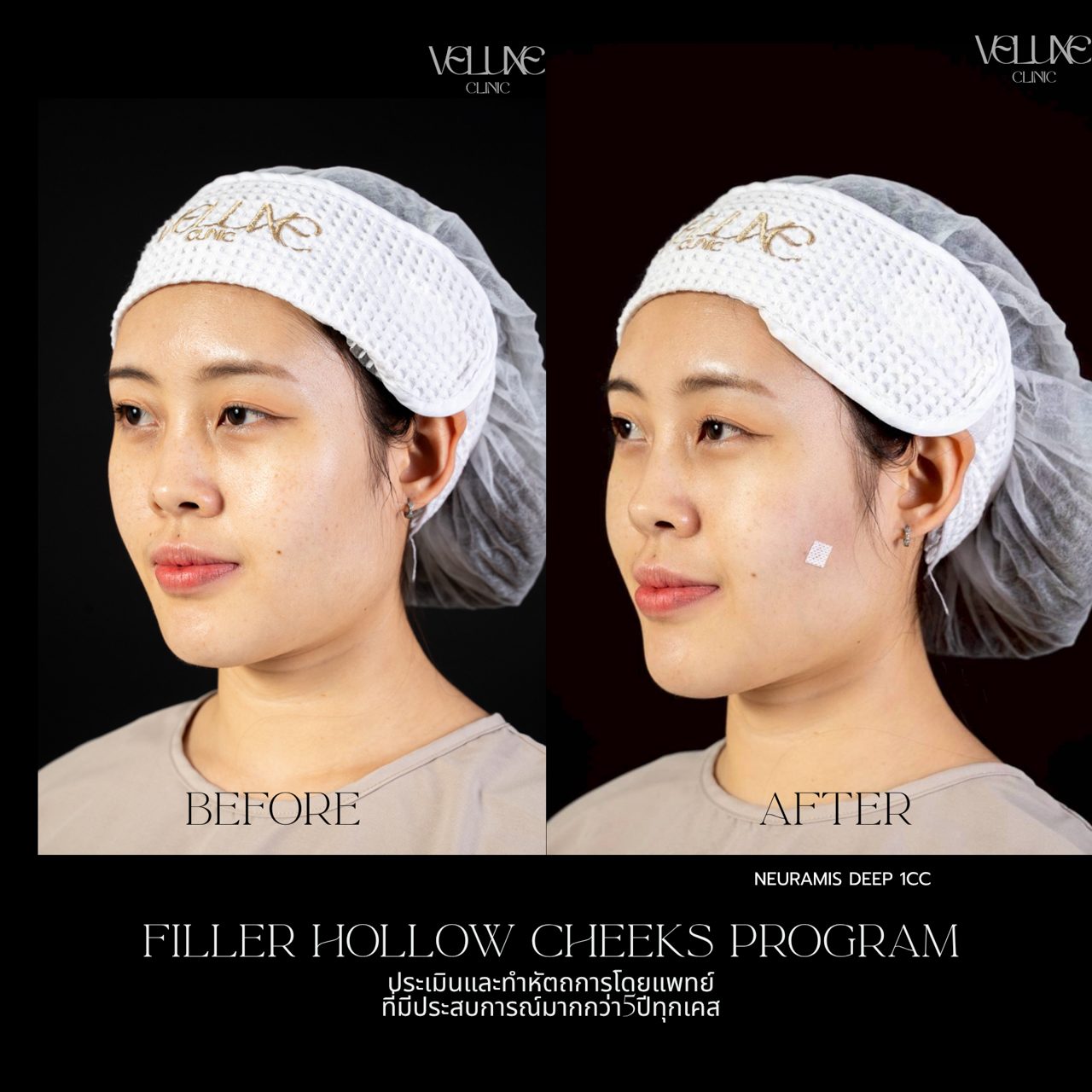 Filler แก้มตอบ