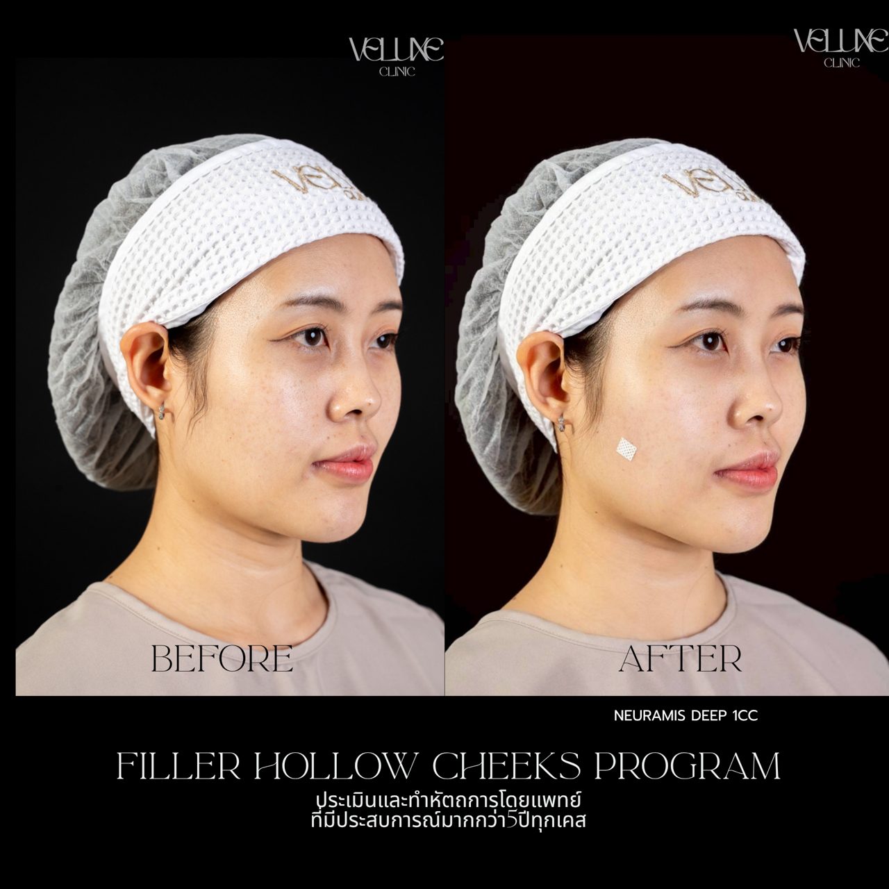 Filler แก้มตอบ
