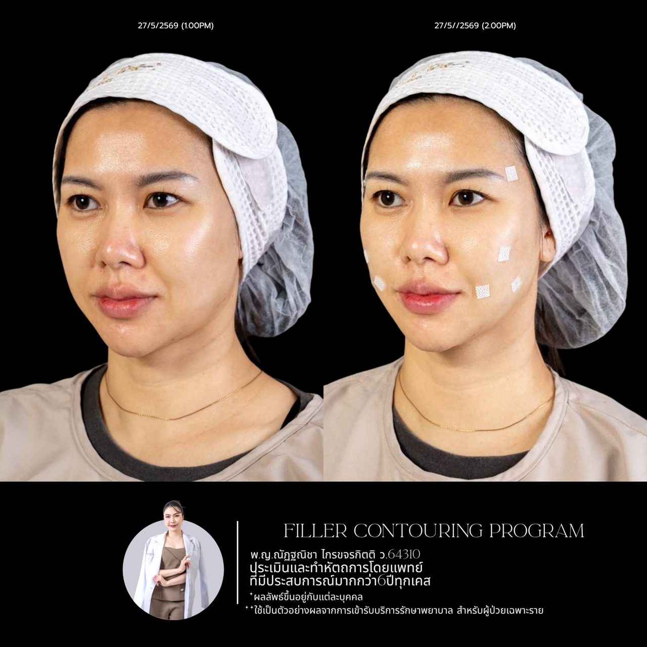 Filler แก้มตอบ