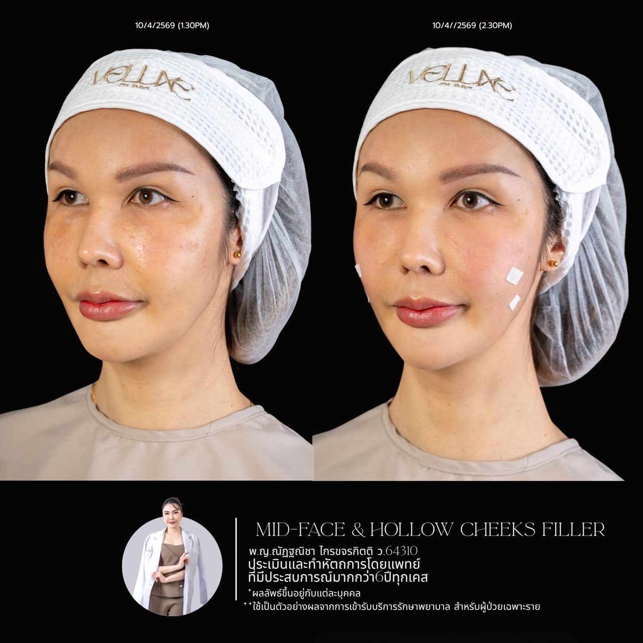 Filler แก้มตอบ