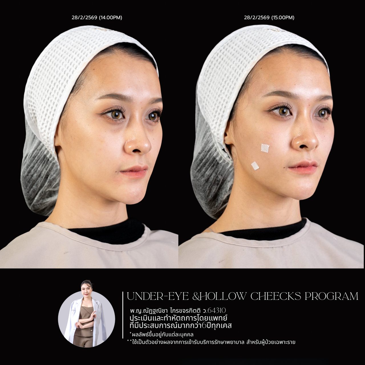 Filler แก้มตอบ