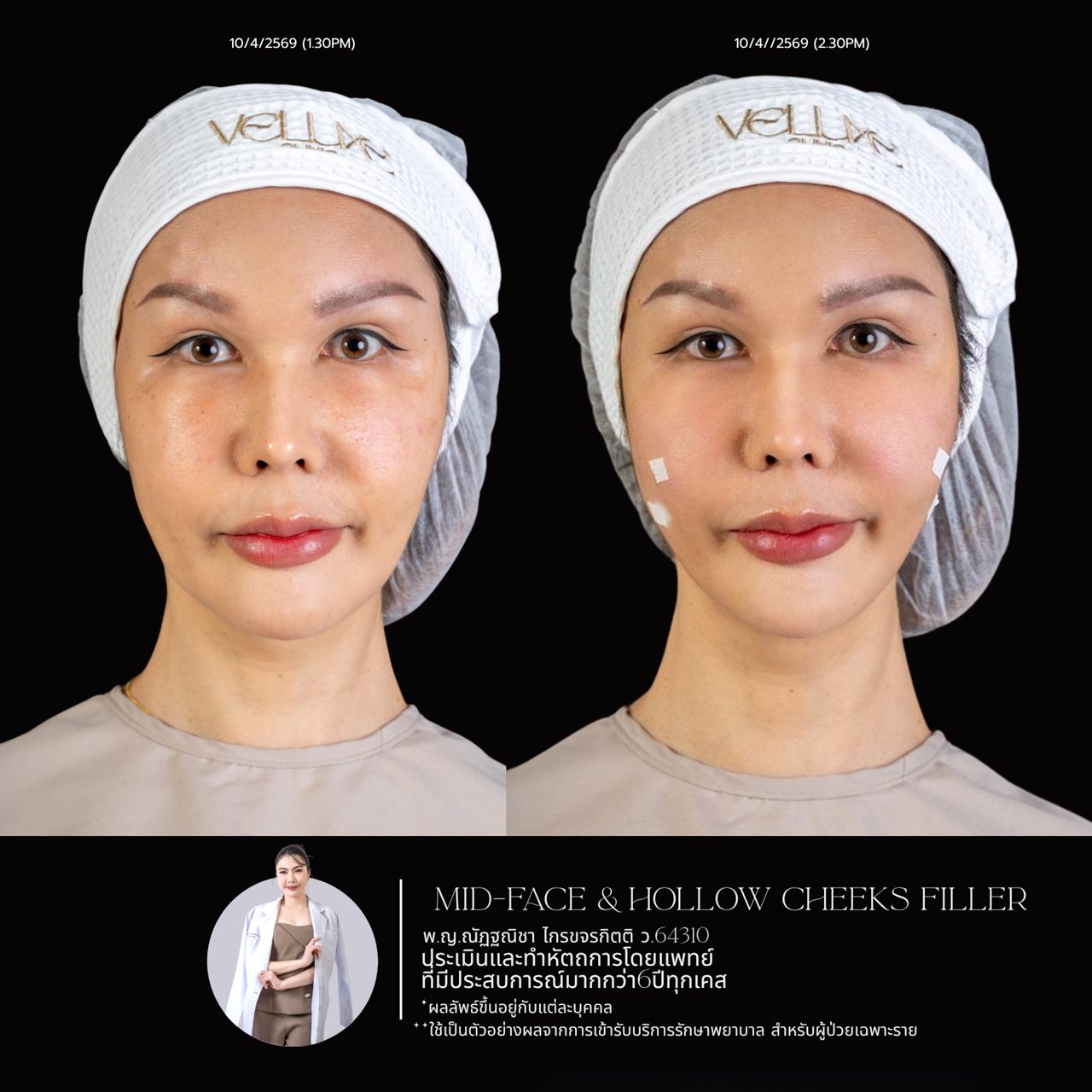 Filler แก้มตอบ