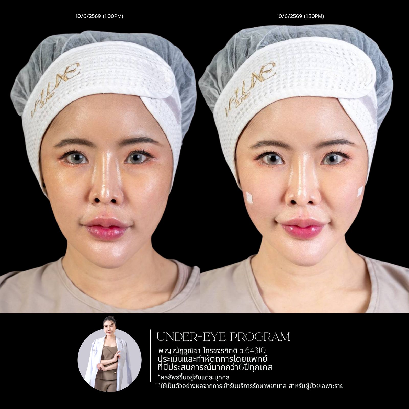 Filler ใต้ตา