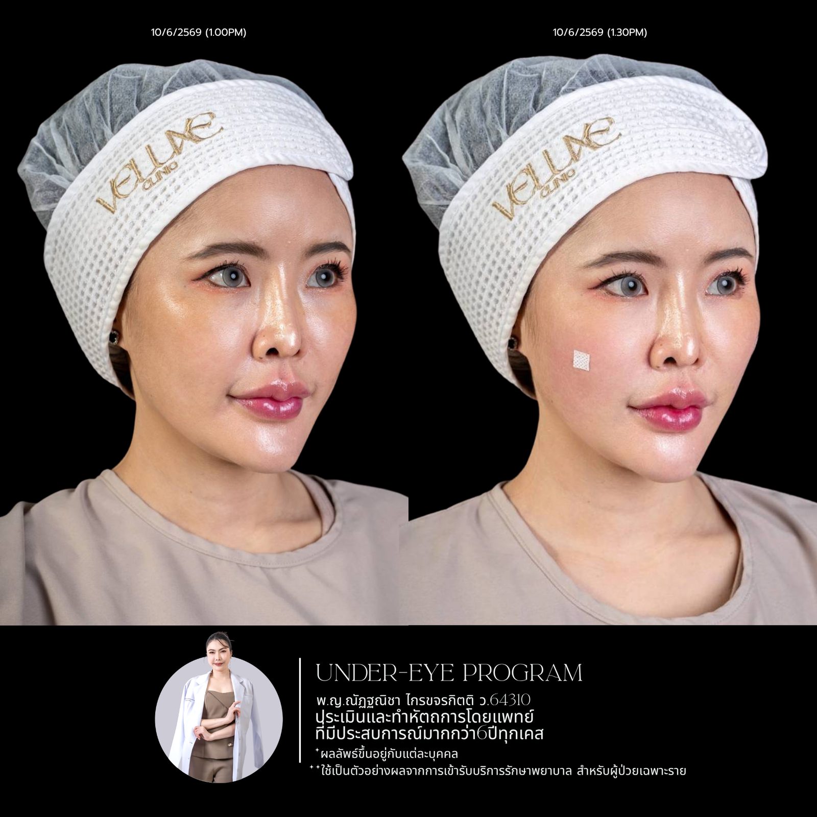Filler ใต้ตา