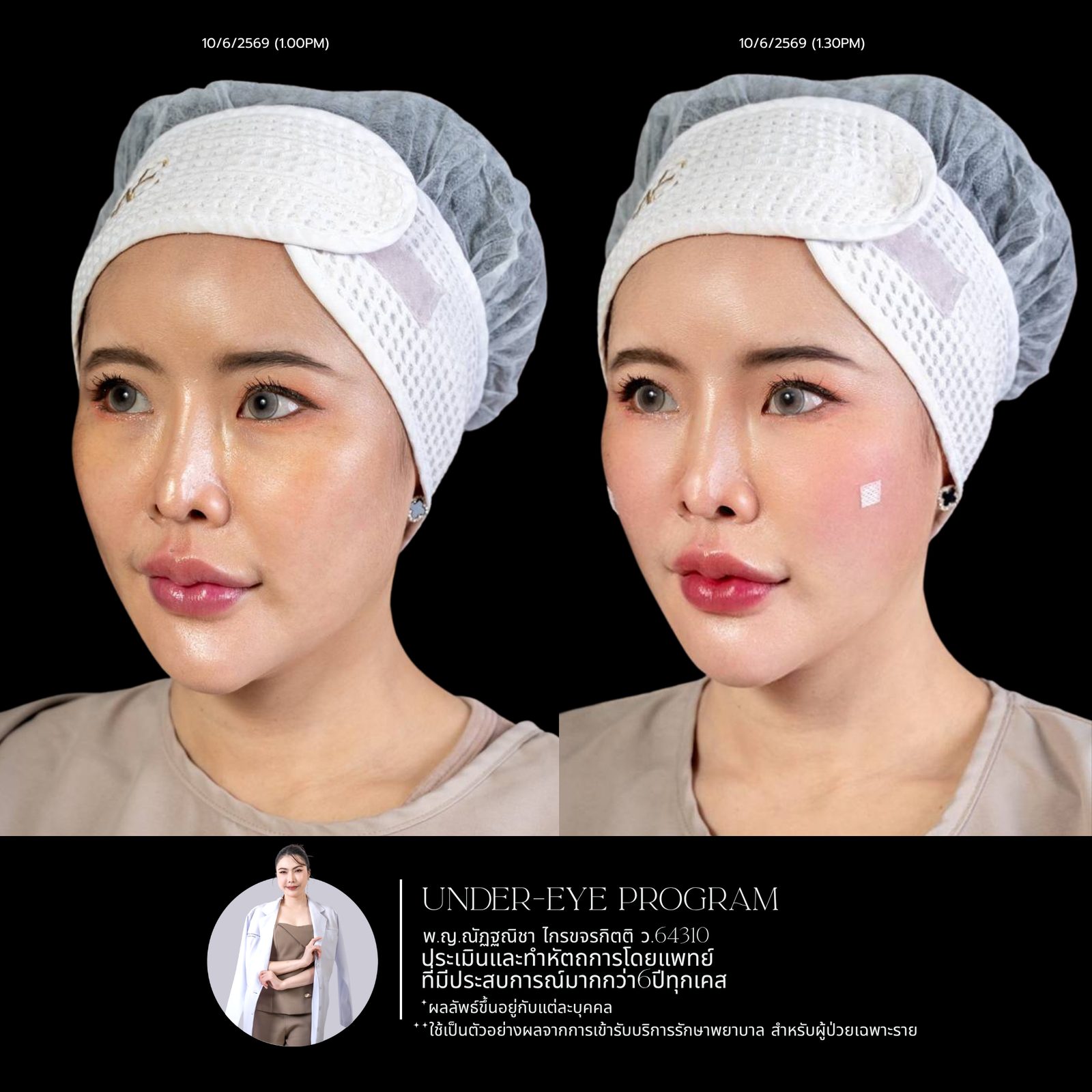 Filler ใต้ตา