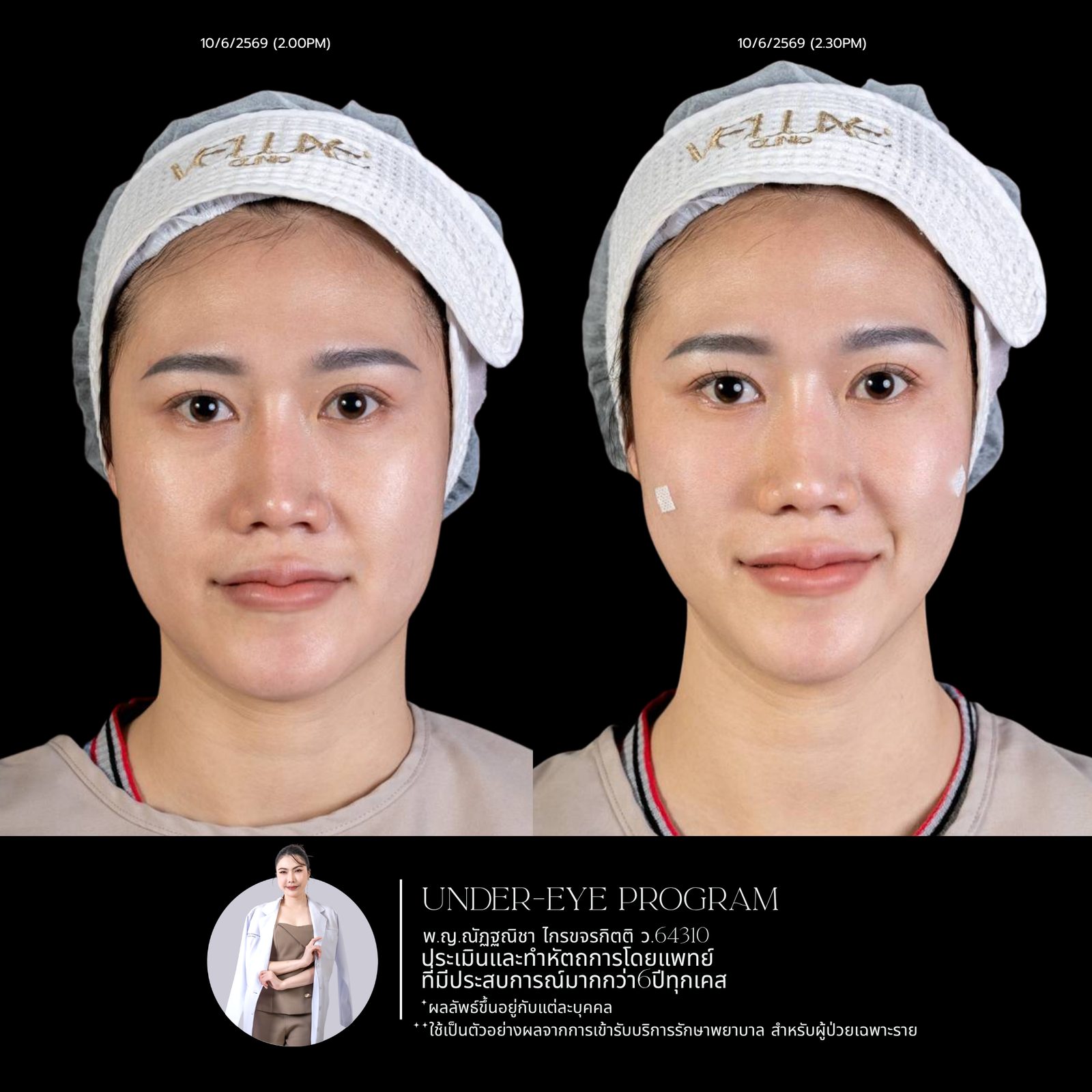 Filler ใต้ตา