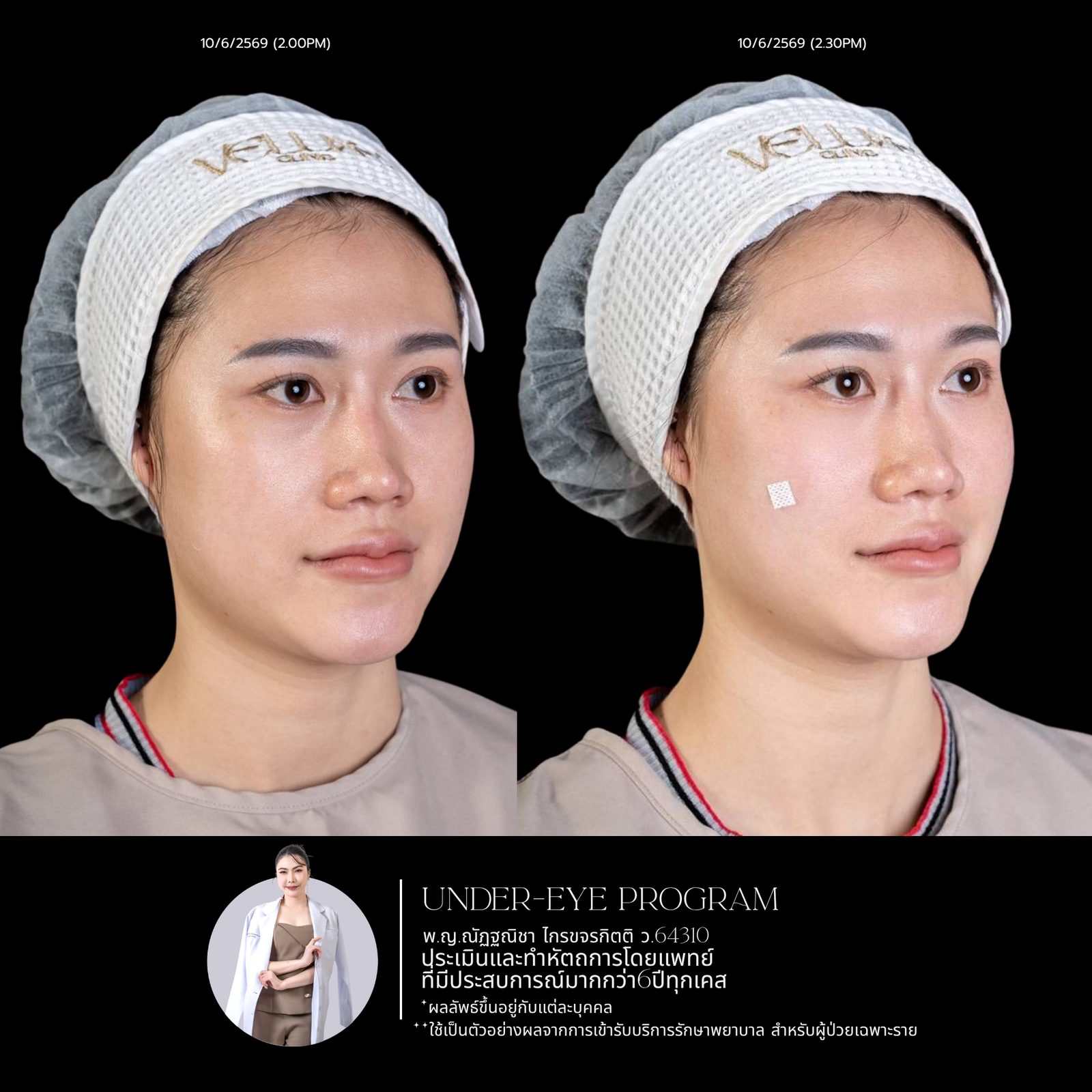 Filler ใต้ตา