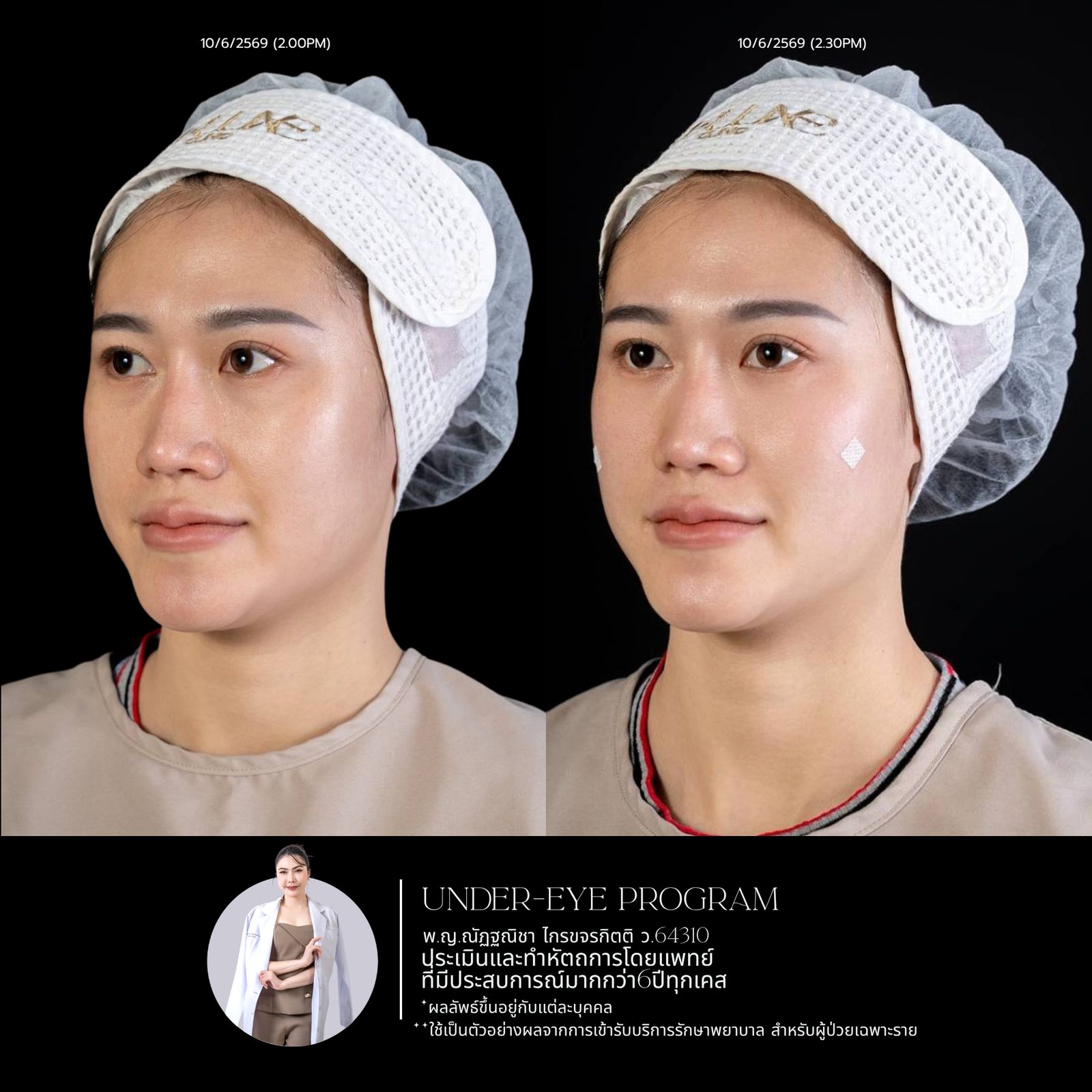 Filler ใต้ตา
