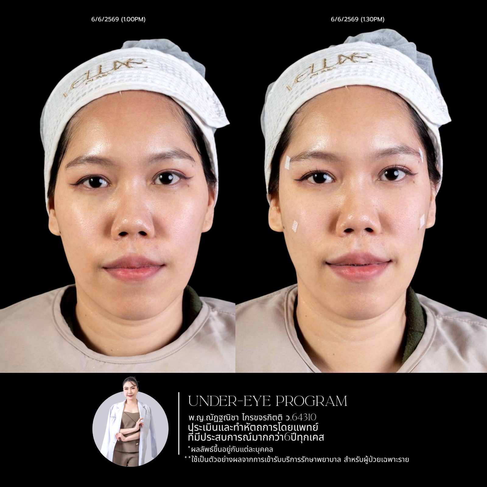 Filler ใต้ตา
