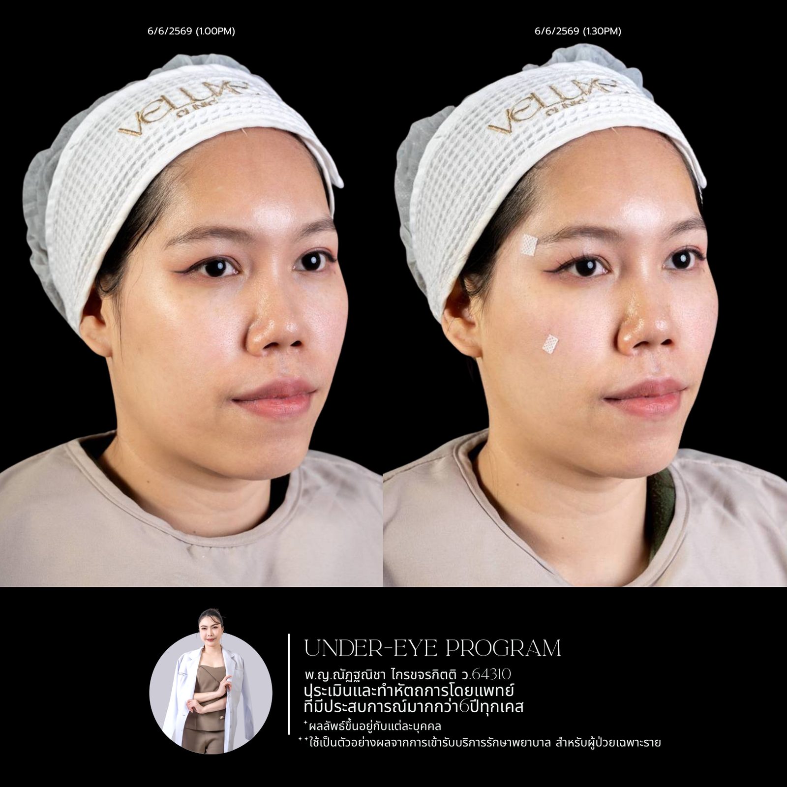 Filler ใต้ตา