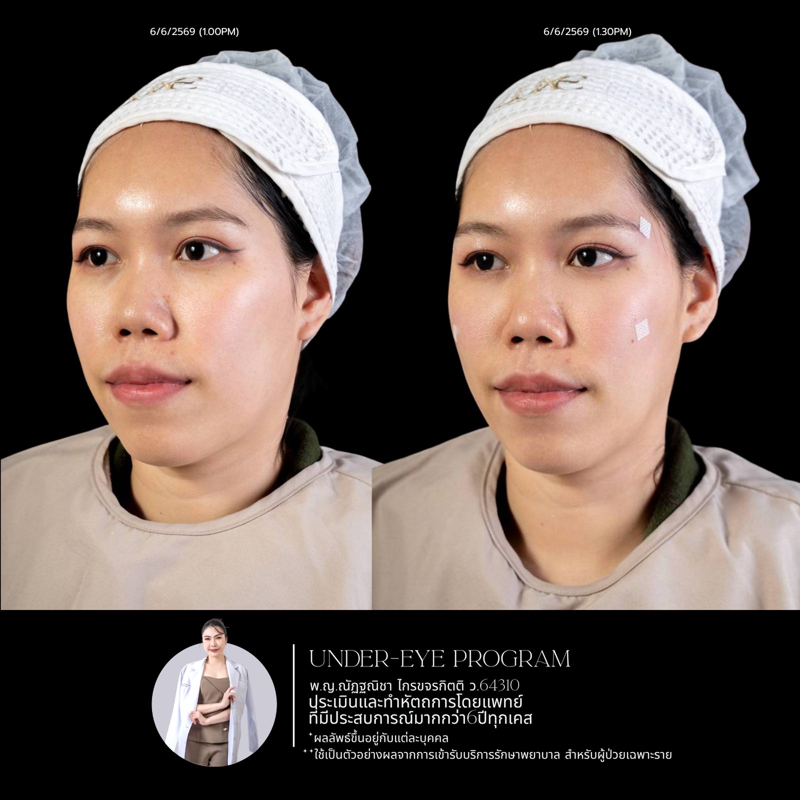 Filler ใต้ตา