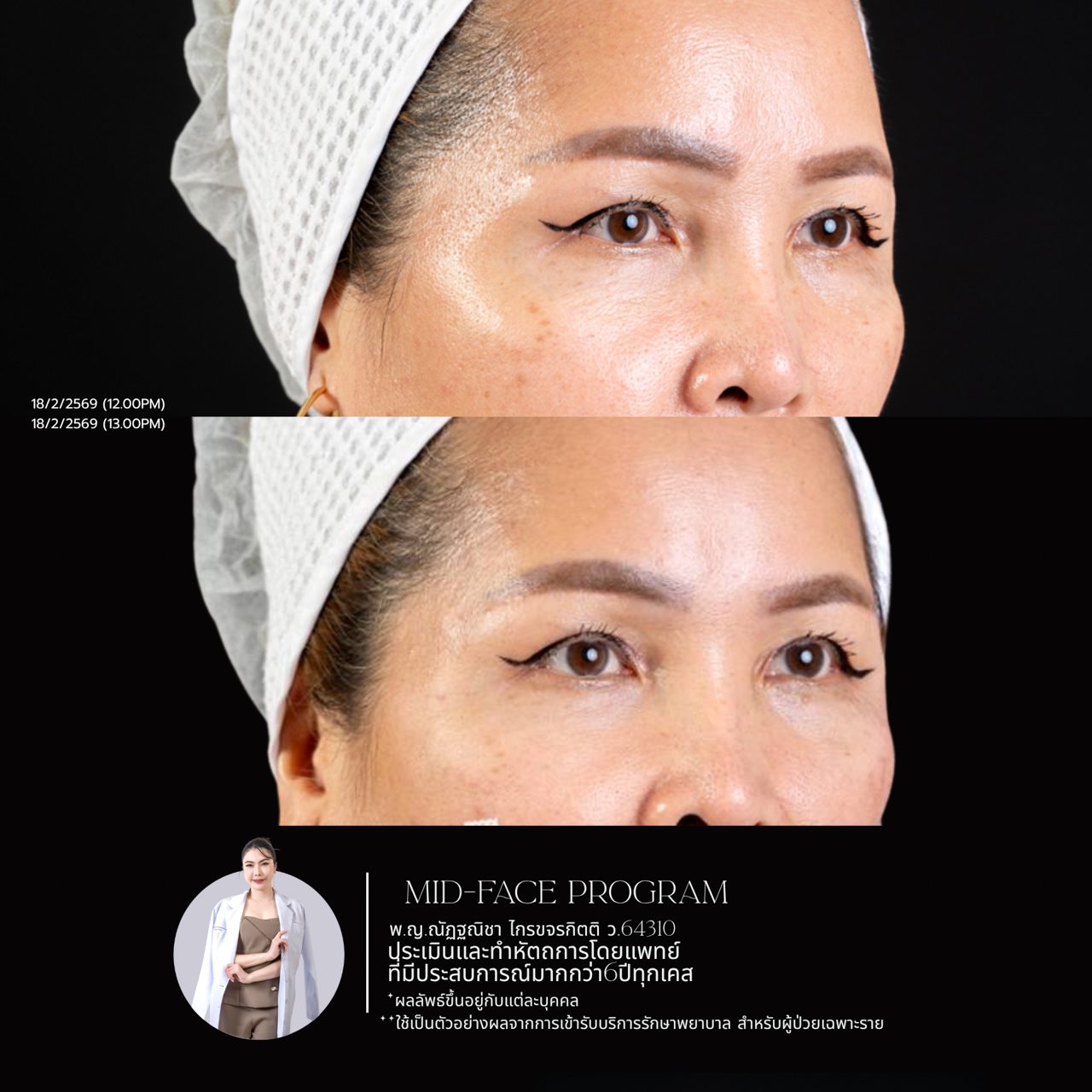 Filler ใต้ตา