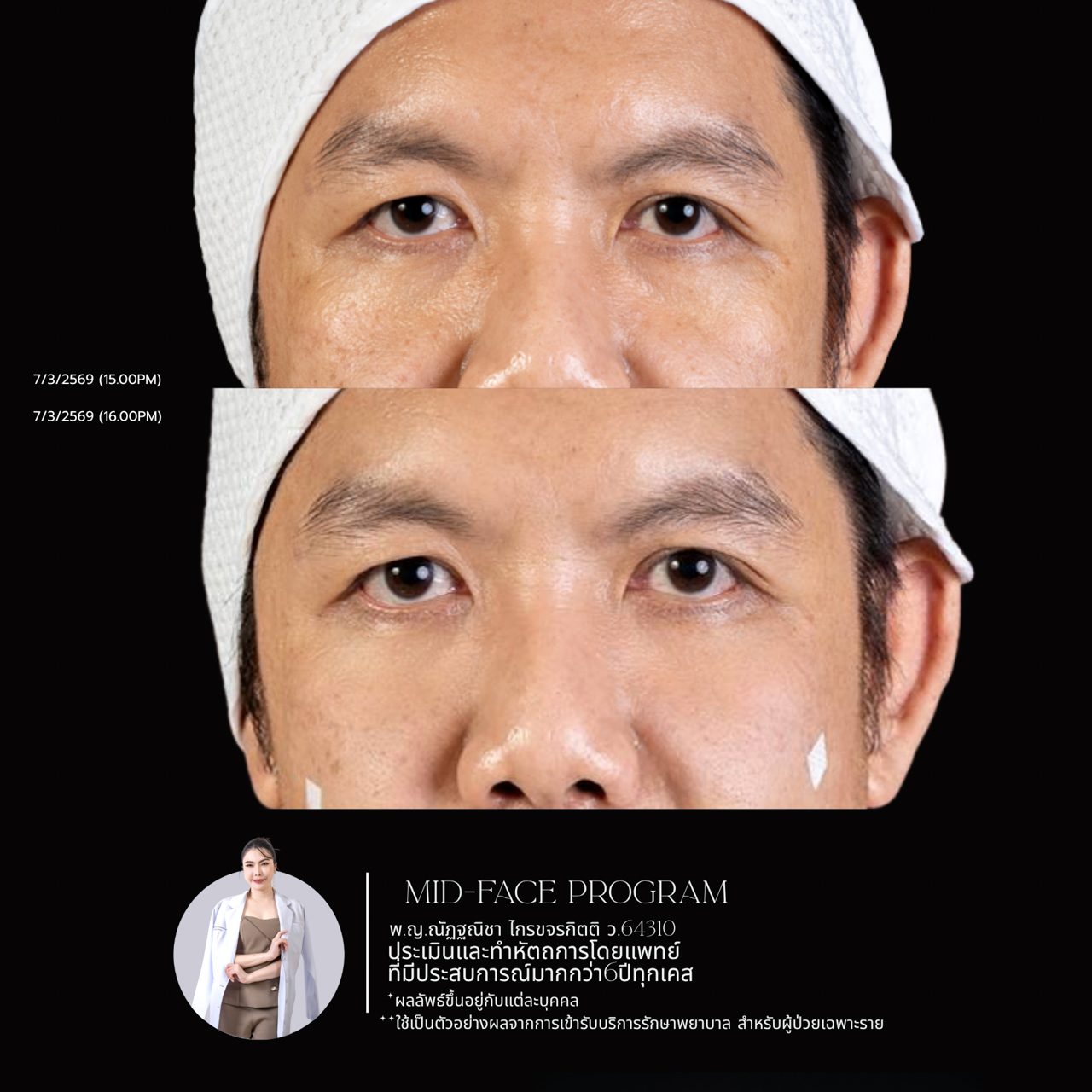 Filler ใต้ตา