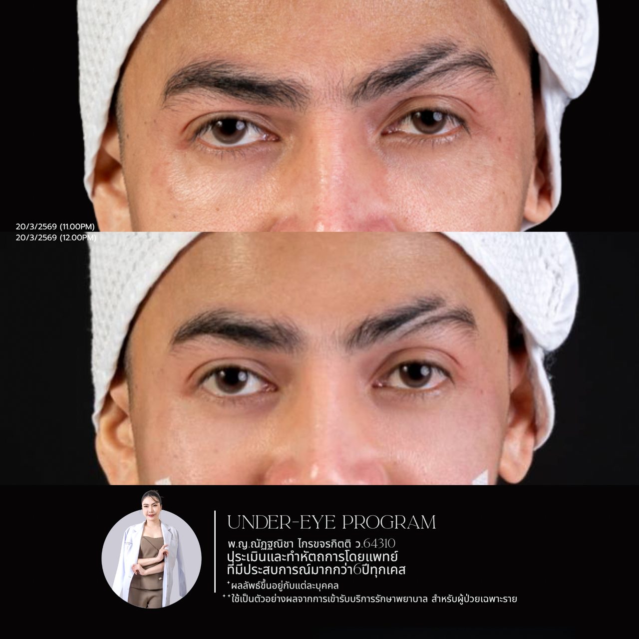 Filler ใต้ตา