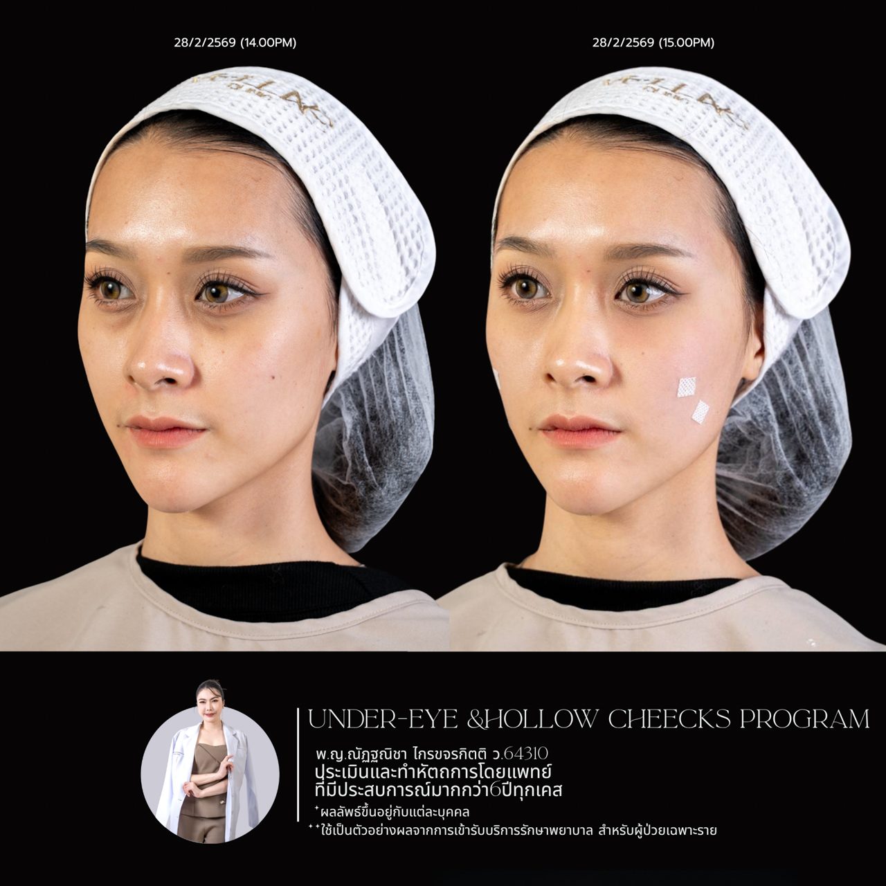 Filler ใต้ตา