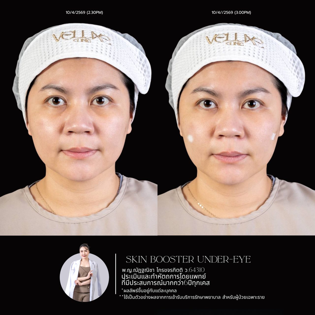 Filler ใต้ตา