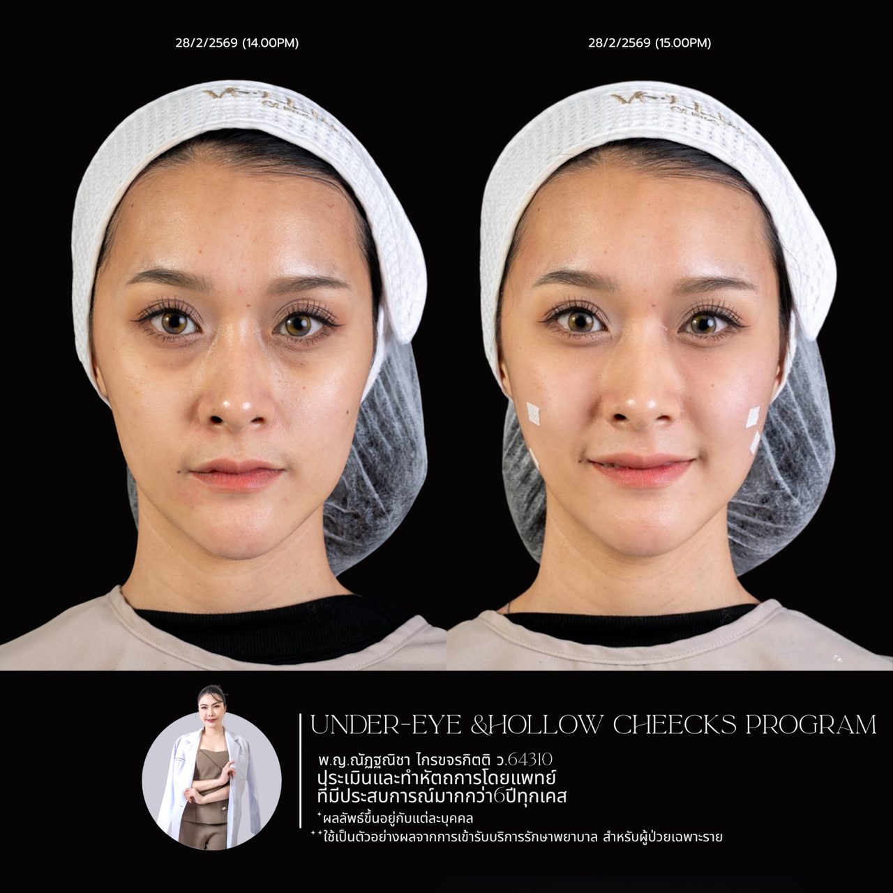 Filler ใต้ตา