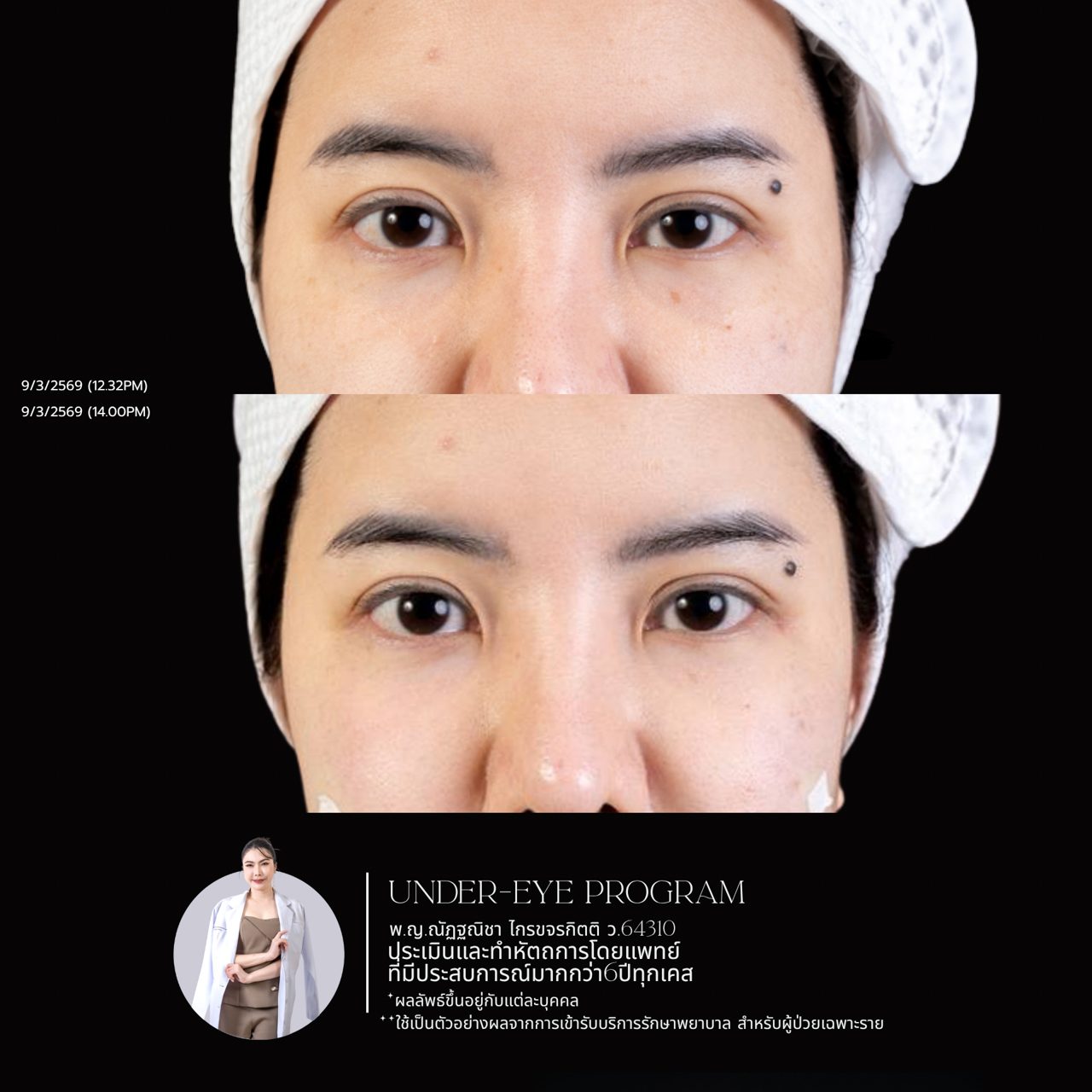 Filler ใต้ตา
