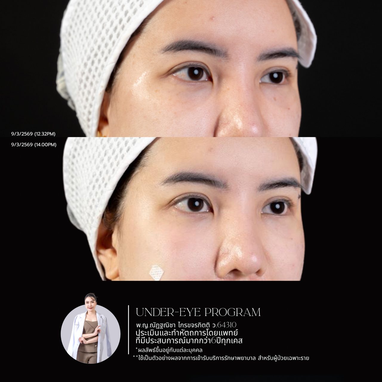 Filler ใต้ตา