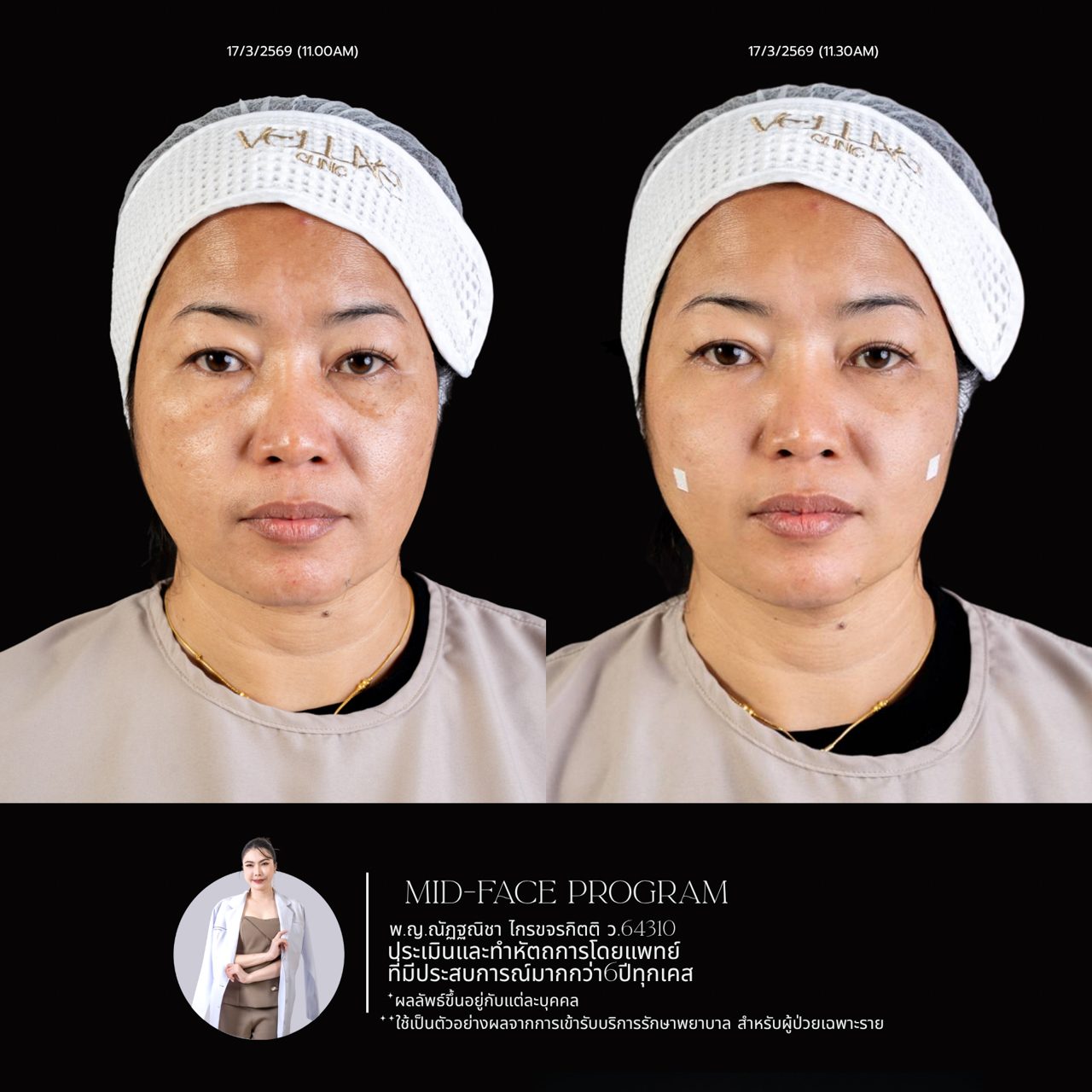 Filler ใต้ตา