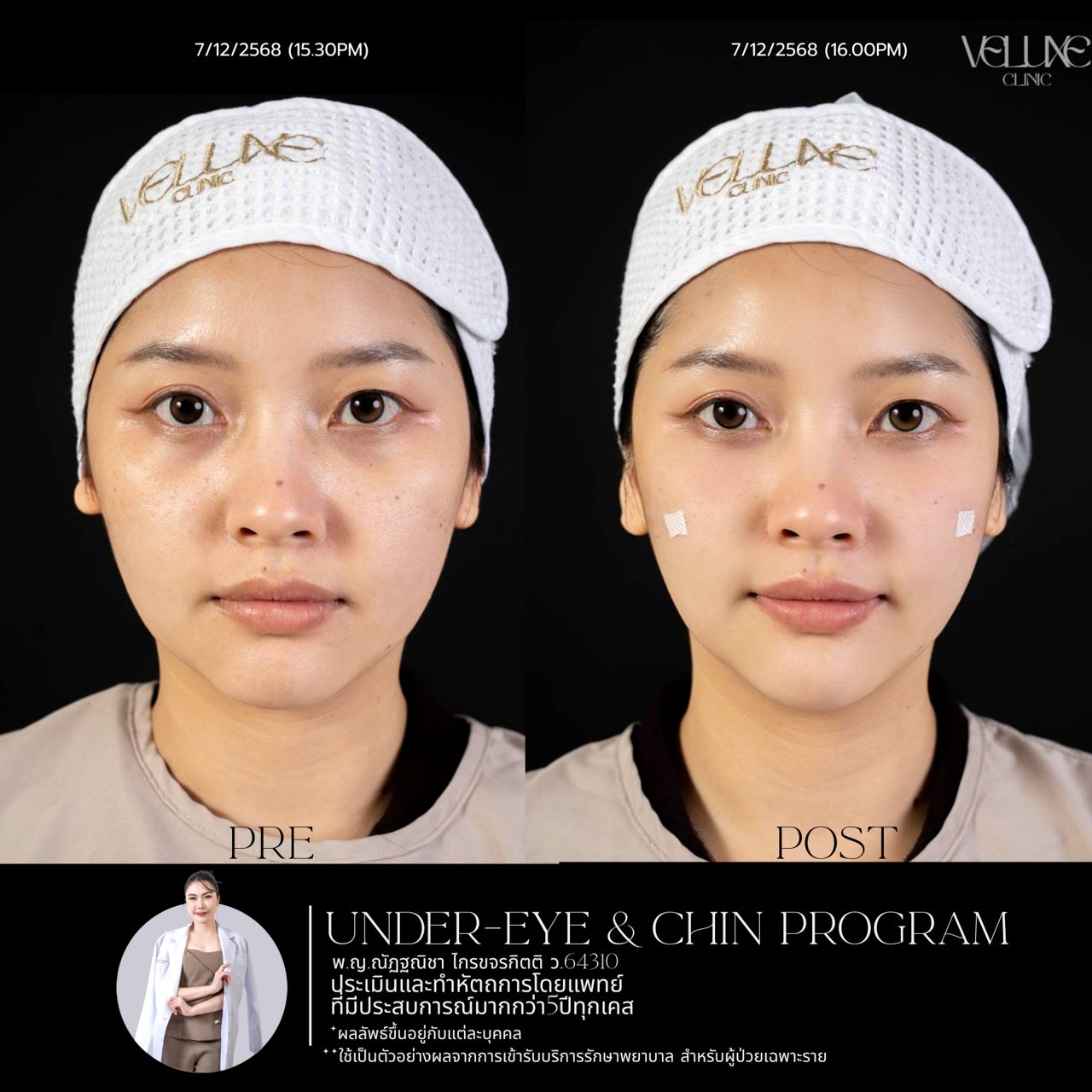 Filler ใต้ตา