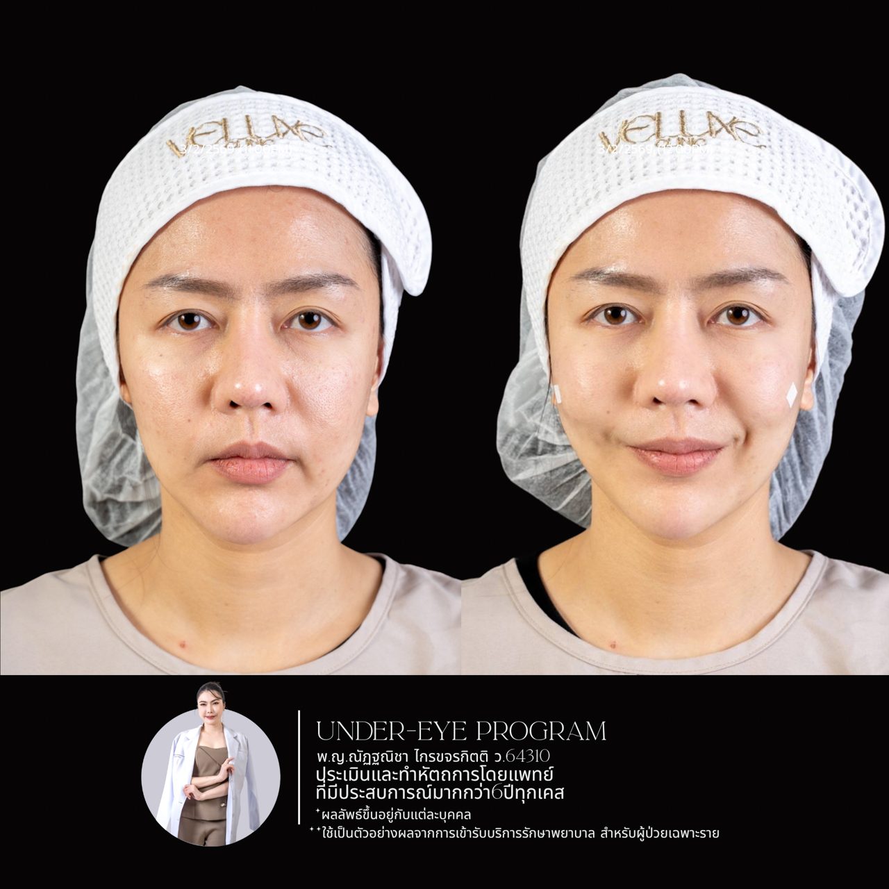 Filler ใต้ตา