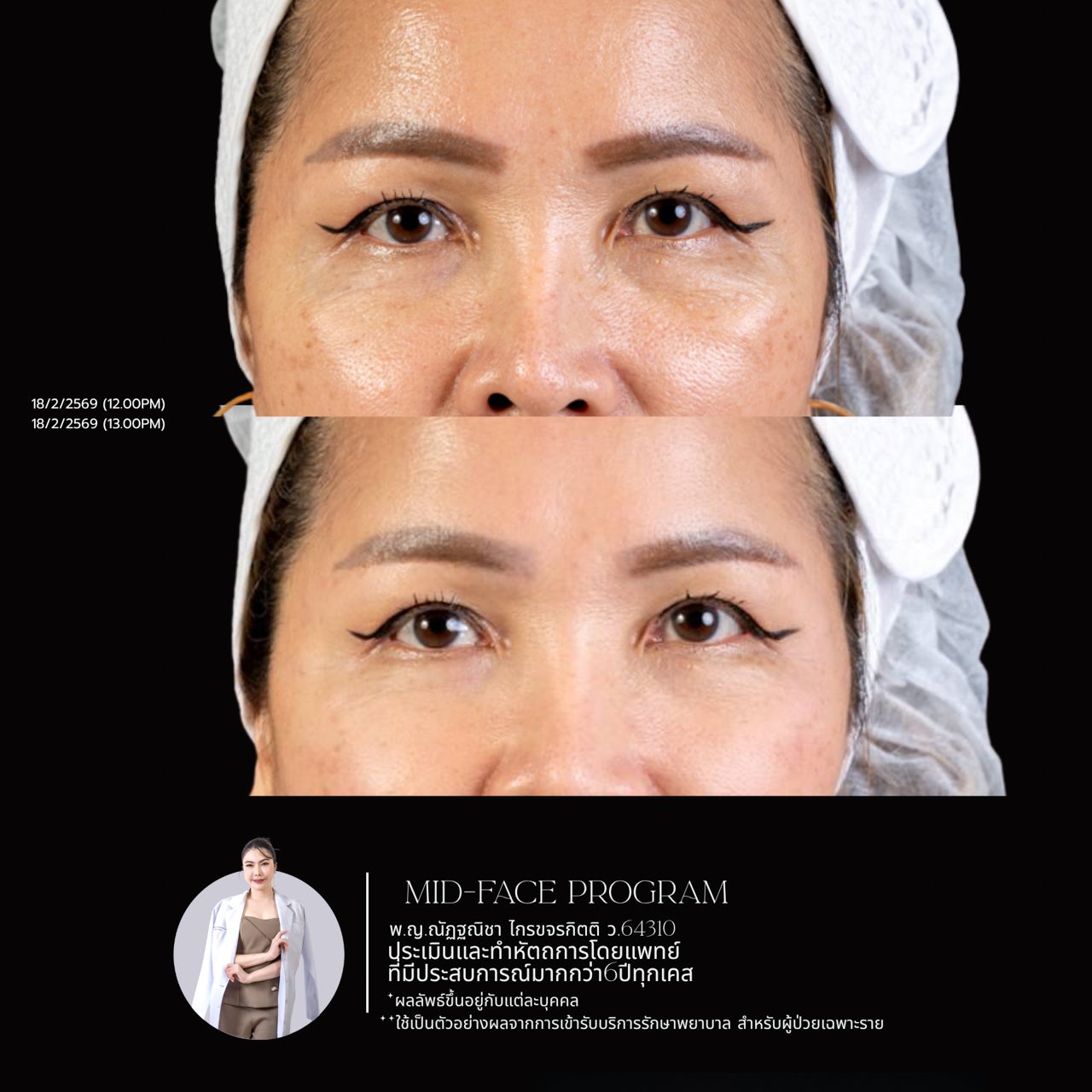Filler ใต้ตา