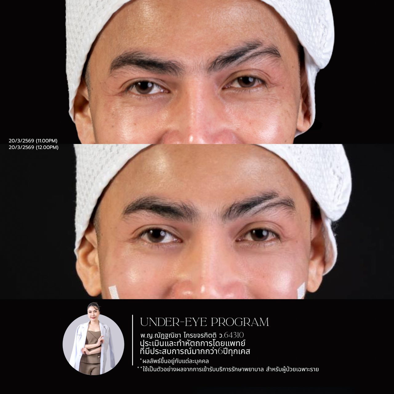 Filler ใต้ตา