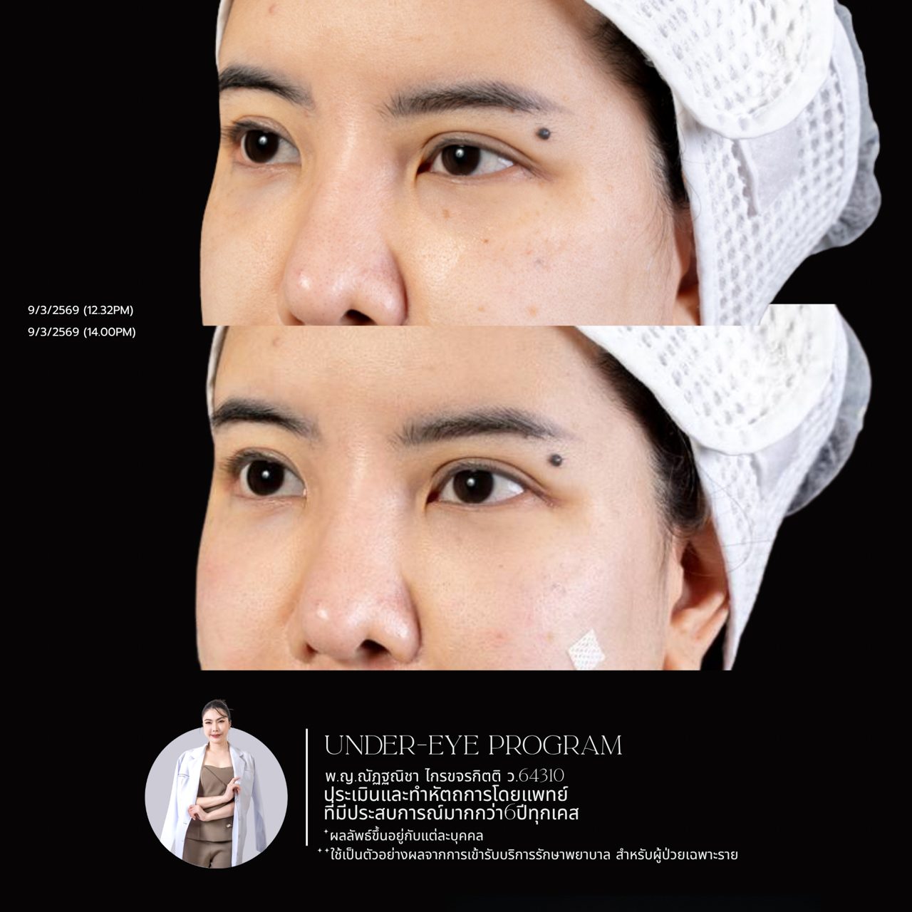 Filler ใต้ตา