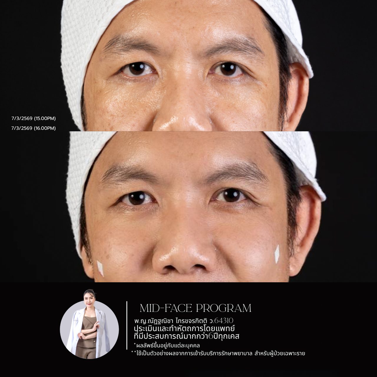 Filler ใต้ตา