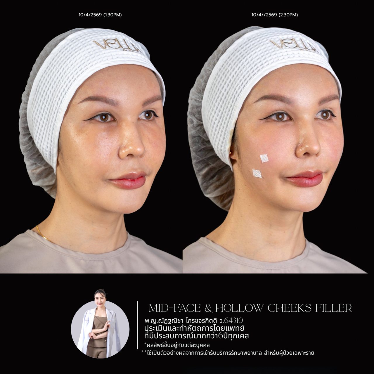 Filler ใต้ตา
