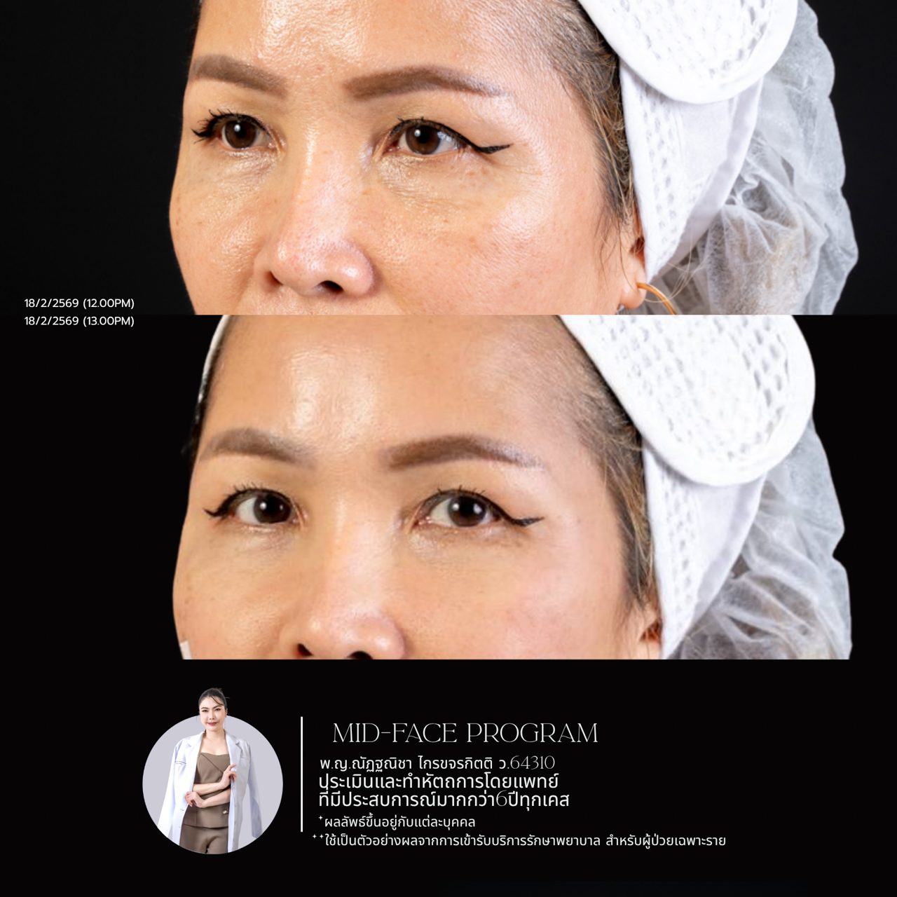 Filler ใต้ตา