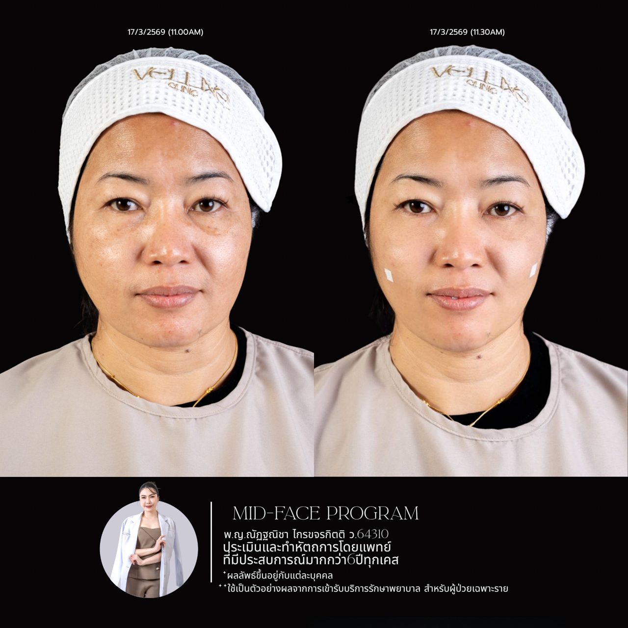 Filler ใต้ตา