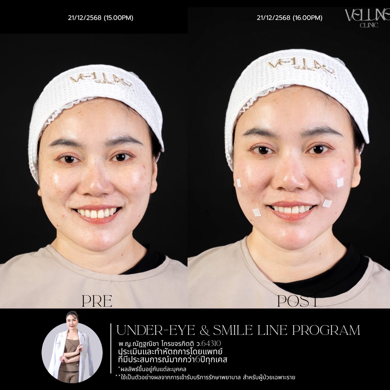 Filler ใต้ตา