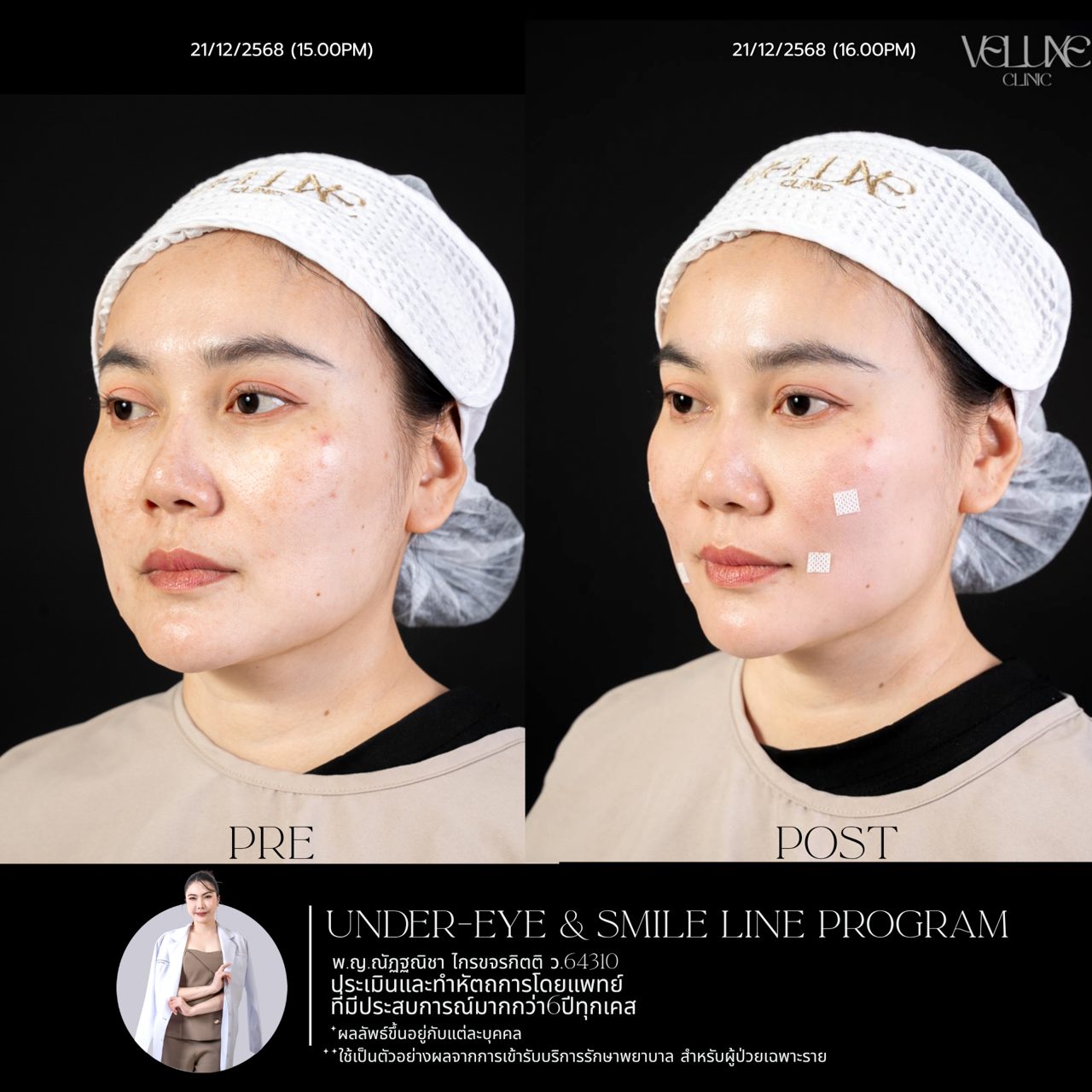 Filler ใต้ตา