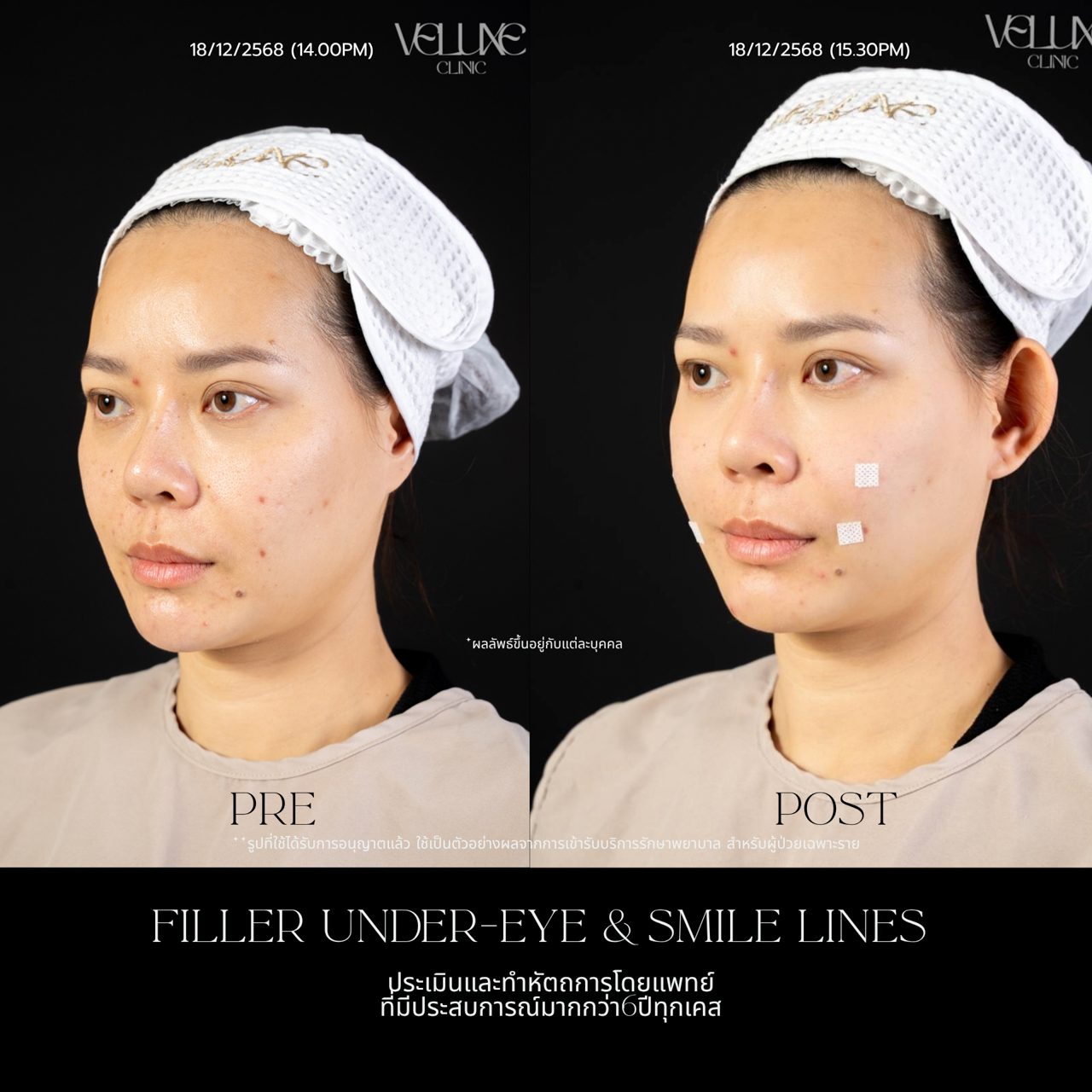 Filler ใต้ตา