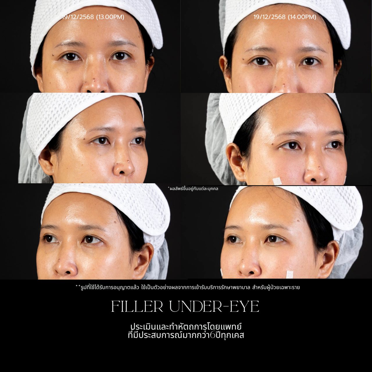 Filler ใต้ตา