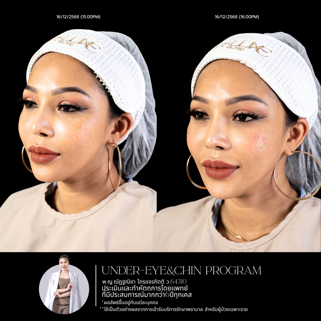 Filler ใต้ตา