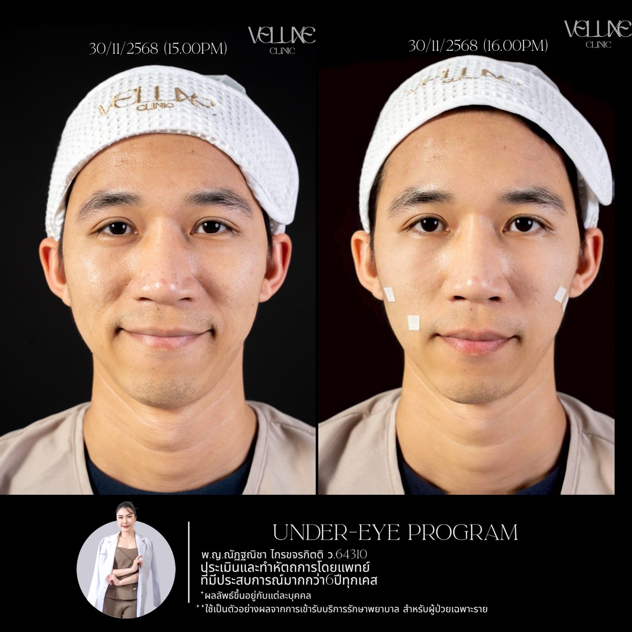 Filler ใต้ตา
