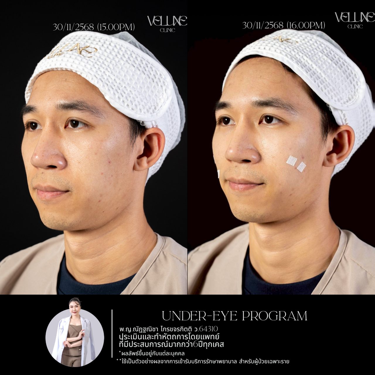 Filler ใต้ตา