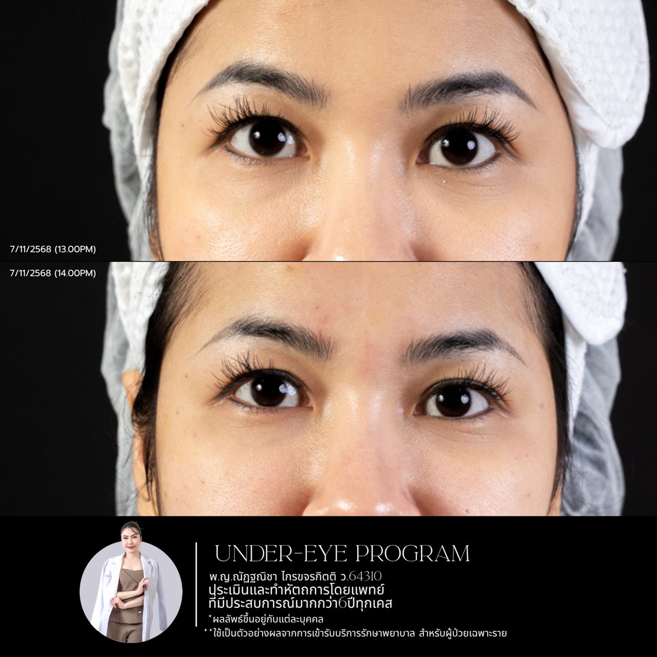Filler ใต้ตา