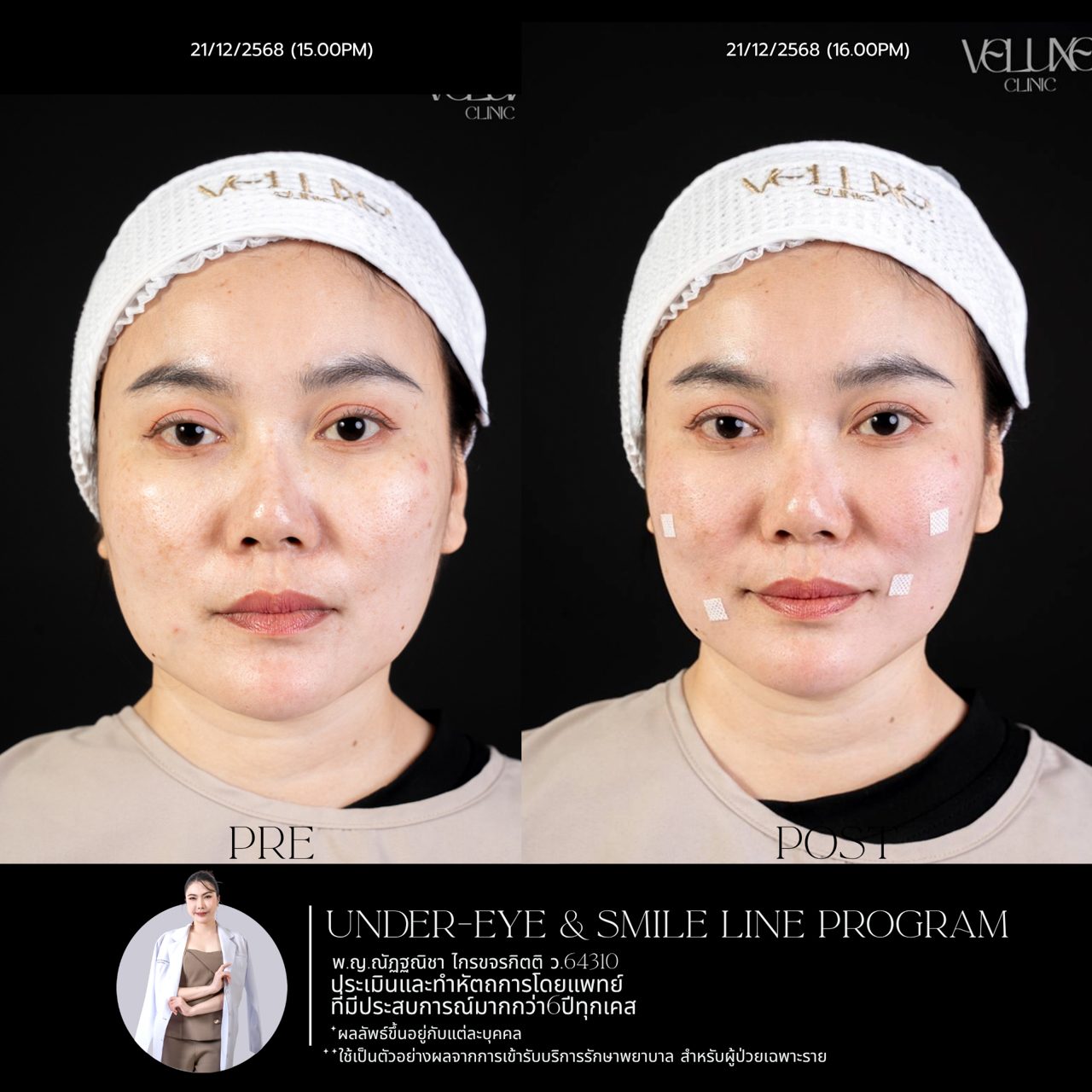 Filler ใต้ตา