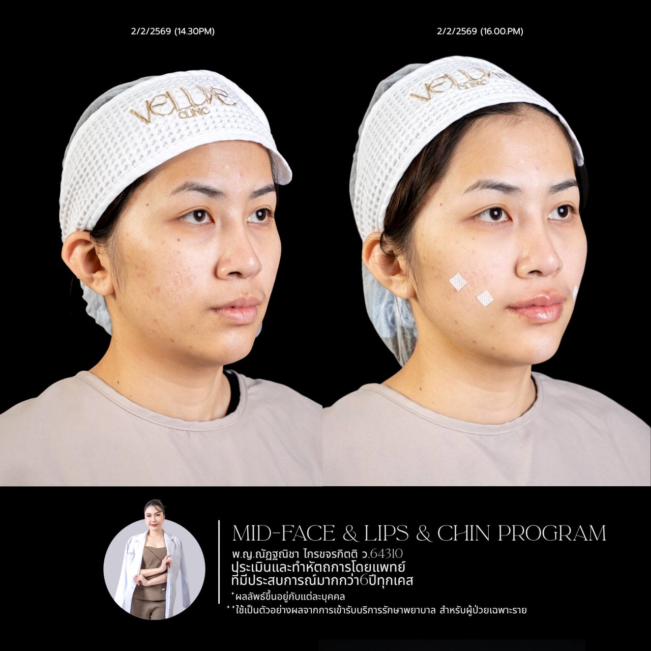 Filler ใต้ตา