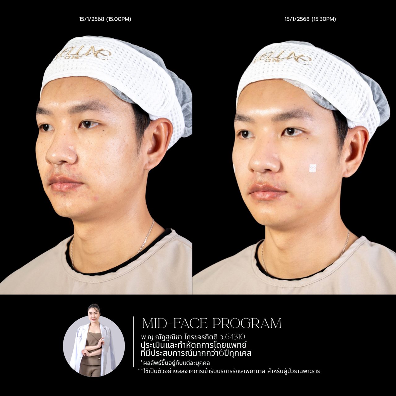 Filler ใต้ตา