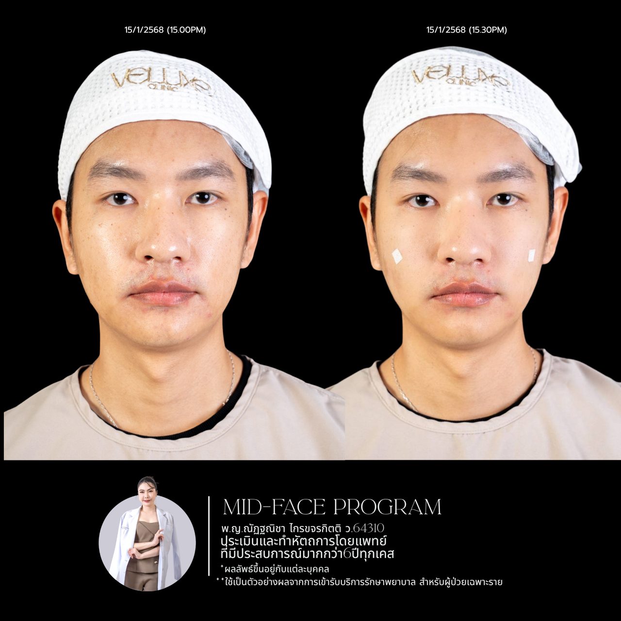 Filler ใต้ตา