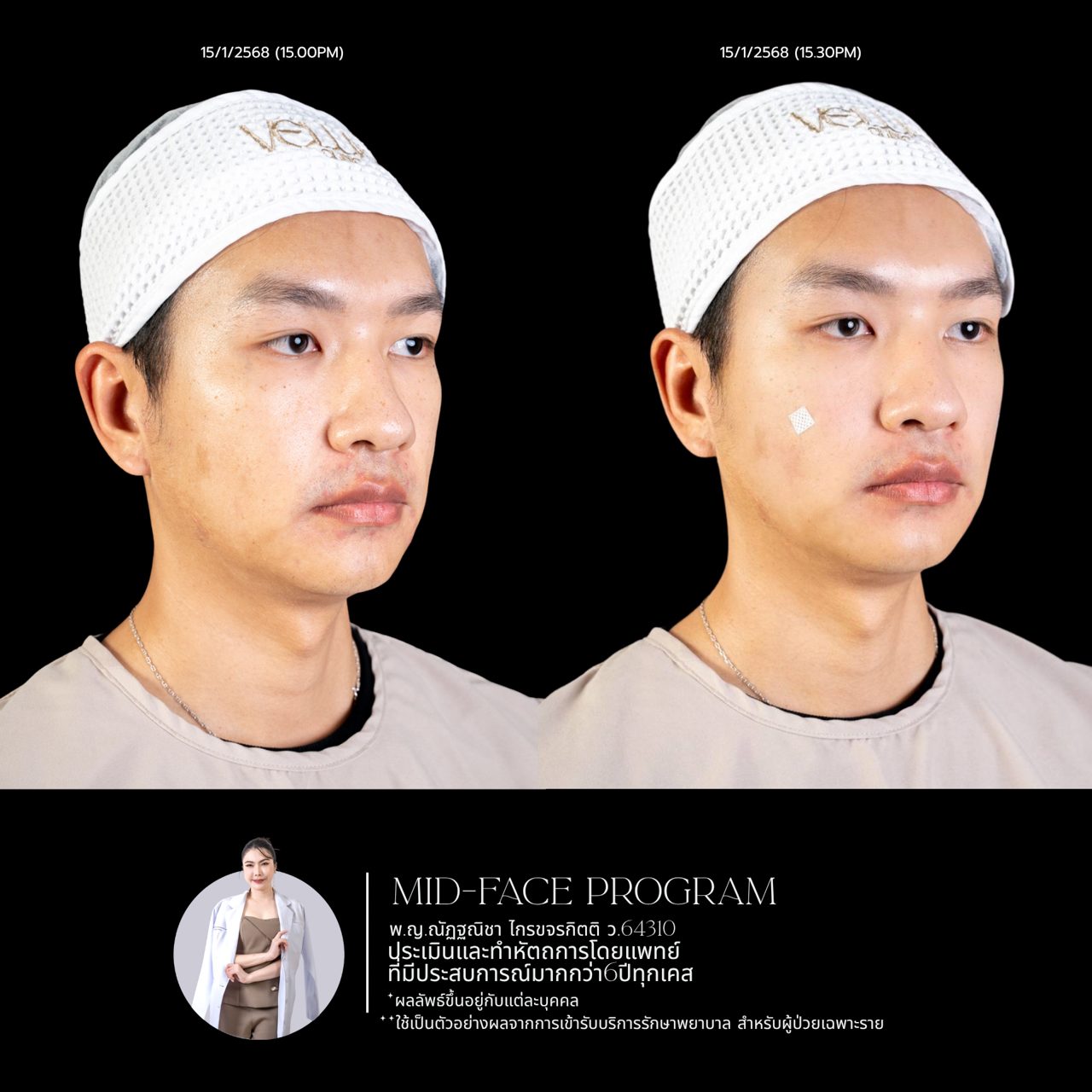 Filler ใต้ตา