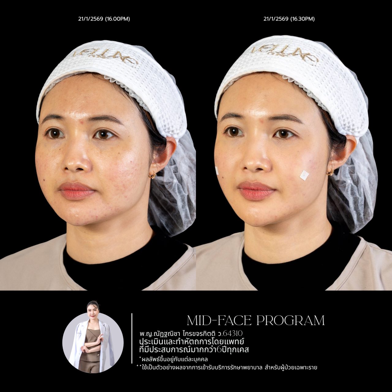 Filler ใต้ตา