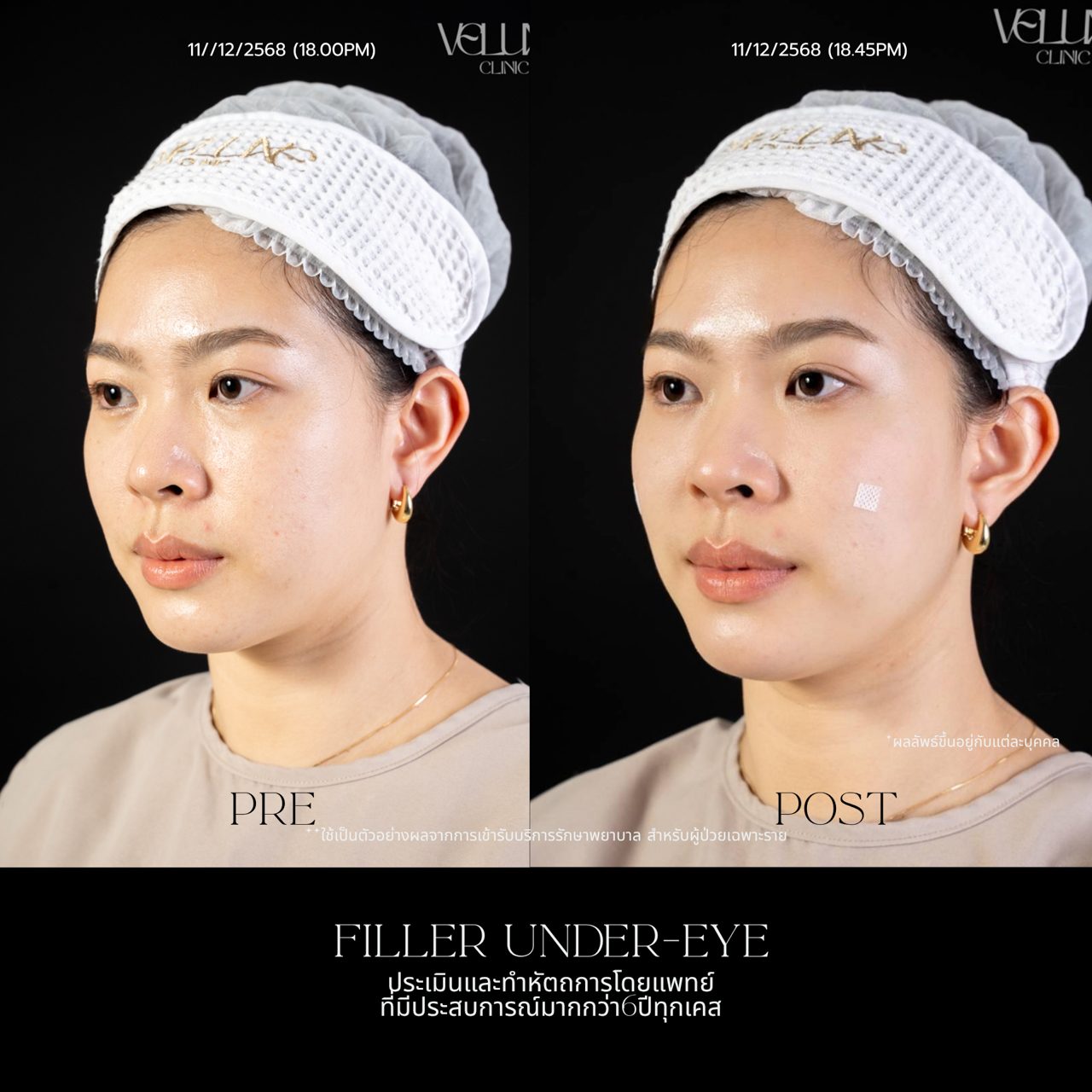 Filler ใต้ตา