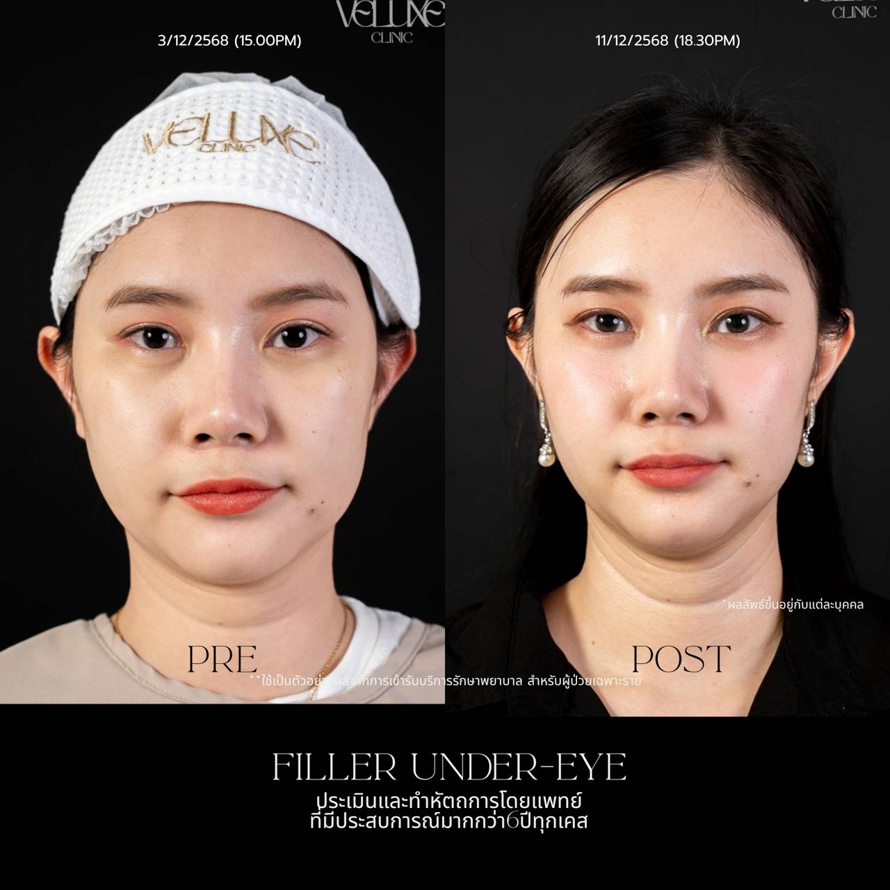 Filler ใต้ตา